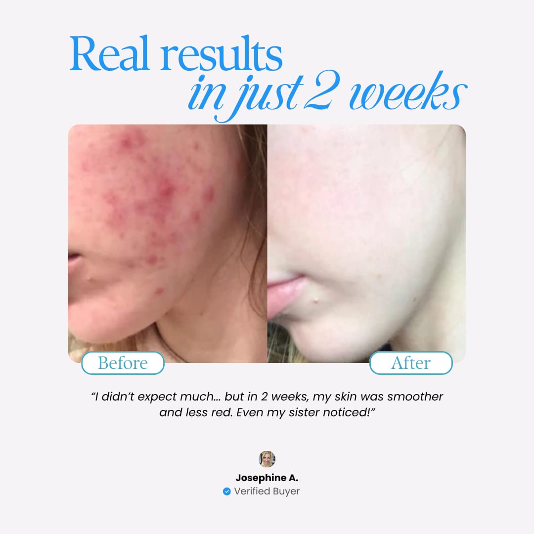 AmoreLumin™ Repair Acne Cream